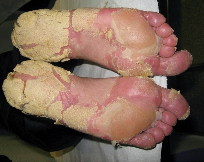 La psoriasis curar en la casa